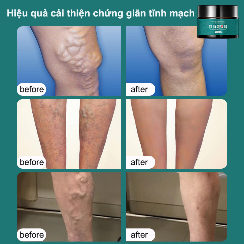 Kem suy giãn tĩnh mạch 20g giúp giảm đau mỏi tê phù chuột rút do suy giãn tĩnh mạch thúc đẩy tuần hoàn máu