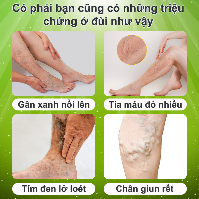 Kem suy giãn tĩnh mạch 20g giúp giảm đau mỏi tê phù chuột rút do suy giãn tĩnh mạch thúc đẩy tuần hoàn máu