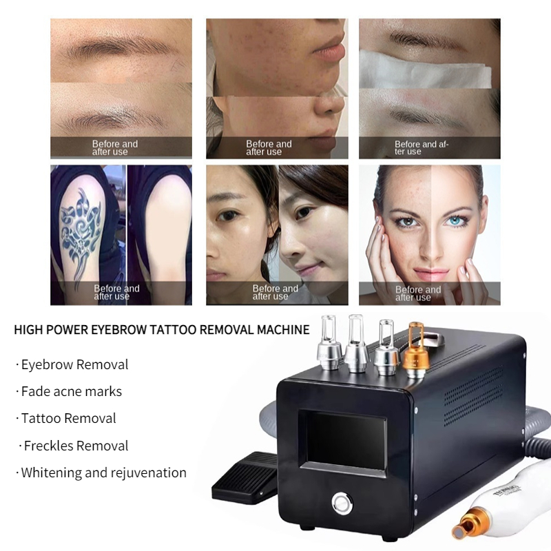 Máy Xoá Xăm Laser Mini di động Không Xâm Lấn - Không Cần Thêm Nước