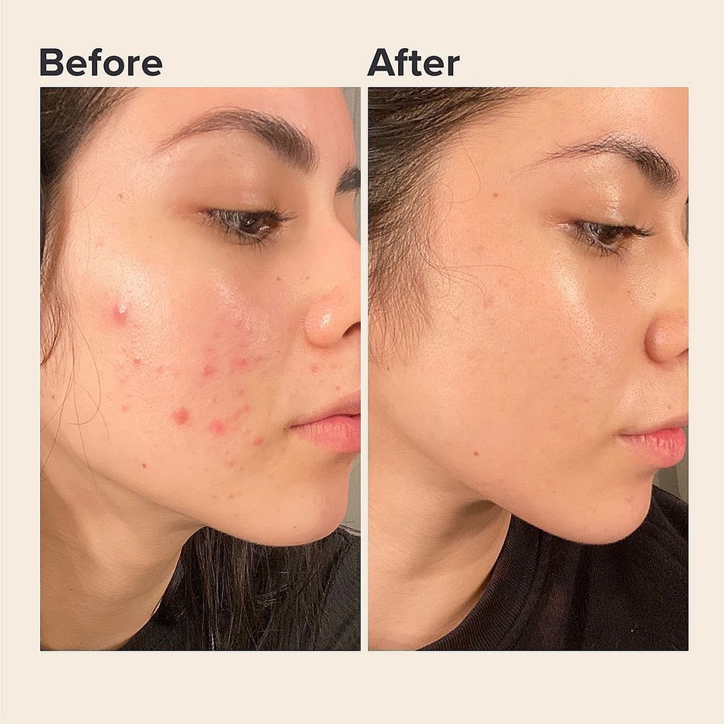 Kem kiểm soát dầu Floslek Anti Acne Mattifying Cream - Kem dưỡng Floslek 50ml