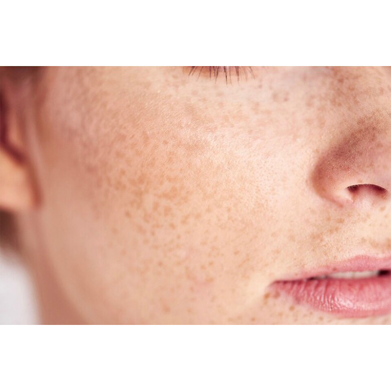 Tinh chất Hoa Hồng giảm thâm nám ISOI BLEMISH CARE UP SERUM