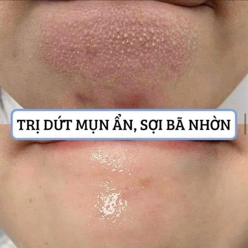 Peel da căng bóng The Ord