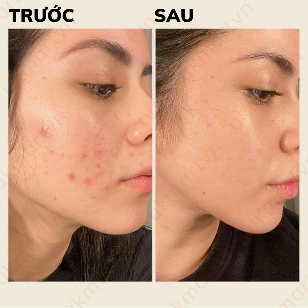 Gel Derma Forte giảm mụn, mờ thâm sẹo bản thường/ advanced 15g