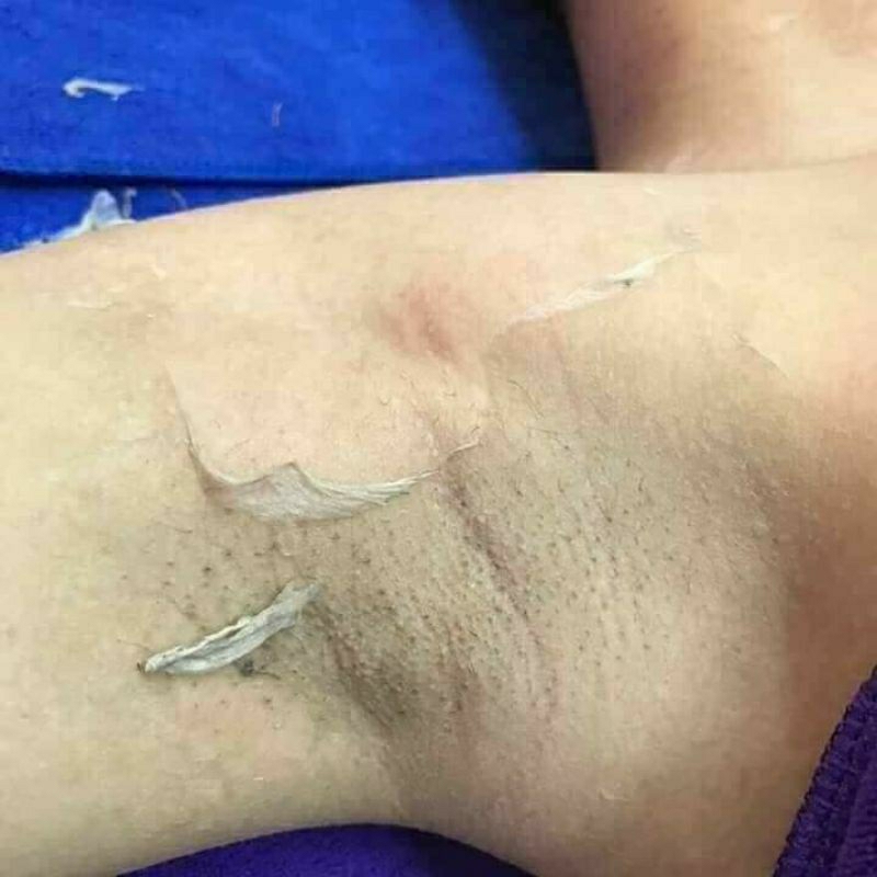 Vi tảo trẻ hóa da,sạch mụn,thâm, nám, tái tạo da tại nhà bong nhanh,mạnh