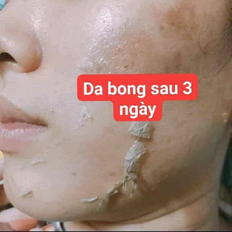 Vi tảo trẻ hóa da,sạch mụn,thâm, nám, tái tạo da tại nhà bong nhanh,mạnh