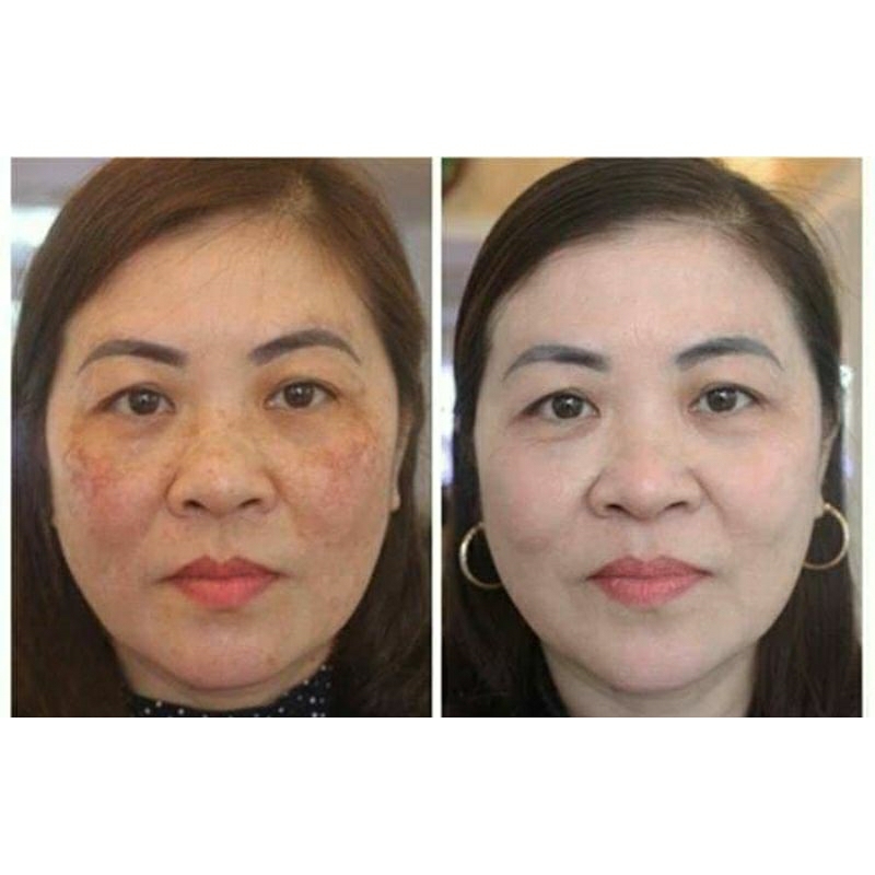 Vi tảo trẻ hóa da,sạch mụn,thâm, nám, tái tạo da tại nhà bong nhanh,mạnh