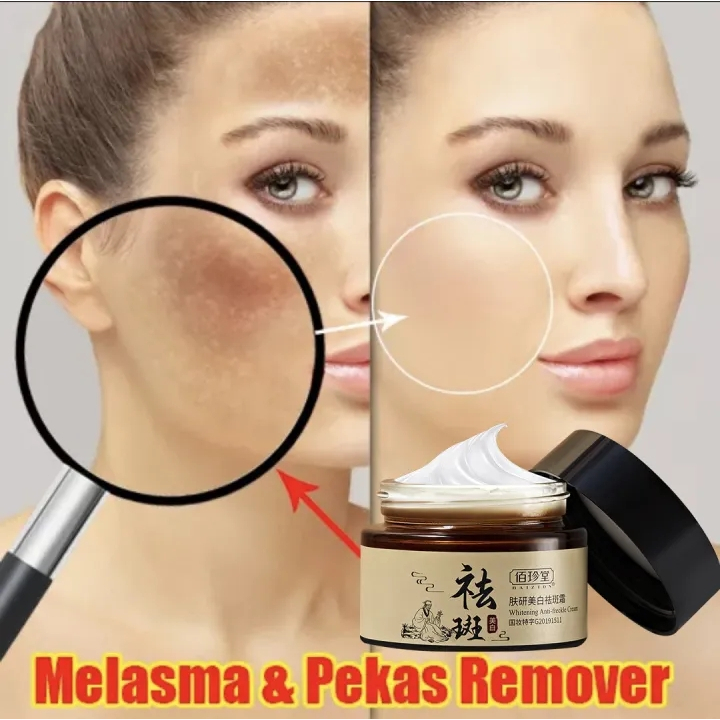 Kem xóa tàn nhang kem xóa nám làm trắng da tinh chất chất làm trắng da mặt và loại bỏ nám làm sáng da chăm sóc 30g kem n
