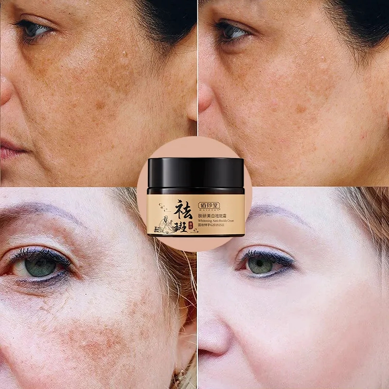 Kem xóa tàn nhang kem xóa nám làm trắng da tinh chất chất làm trắng da mặt và loại bỏ nám làm sáng da chăm sóc 30g kem n