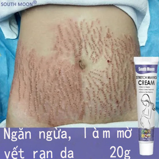 (Xóa rạn da nhanh chóng trong 7 ngày) Kem xoá rạn da sau sinh làm mờ vết thâm sáng đều màu da cải thiện sẹo lâu năm kem