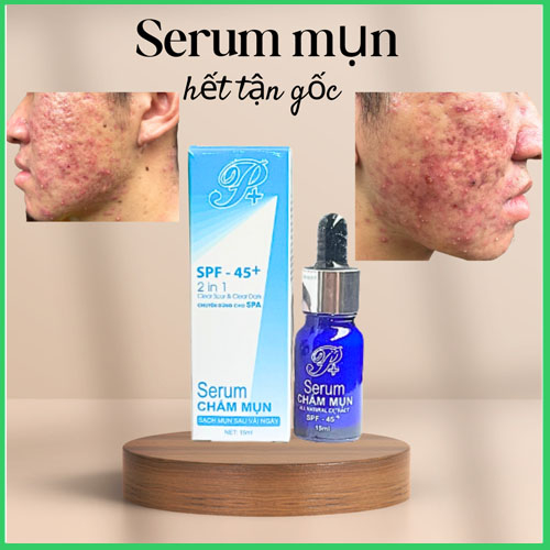 Kem mụn thâm cân bằng da P+ spa 15ml