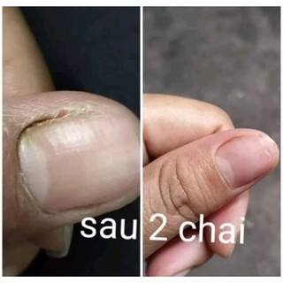 2chai đánh bay nấm móng (SH CHÍNH HÃNG)