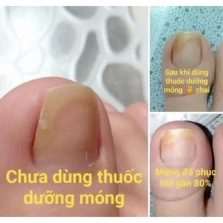 2chai đánh bay nấm móng (SH CHÍNH HÃNG)
