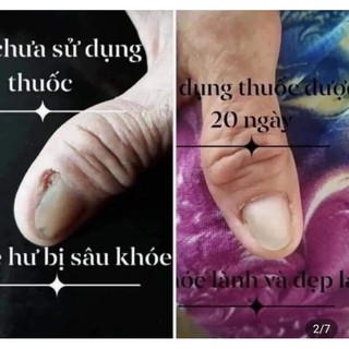2chai đánh bay nấm móng (SH CHÍNH HÃNG)