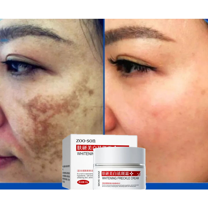 【Loại bỏ tàn nhang nhanh chóng】 Kem làm trắng da và loại bỏ tàn nhang, loại bỏ vết nám, làm mờ vết thâm, giảm tàn nhang, | BigBuy360 - bigbuy360.vn