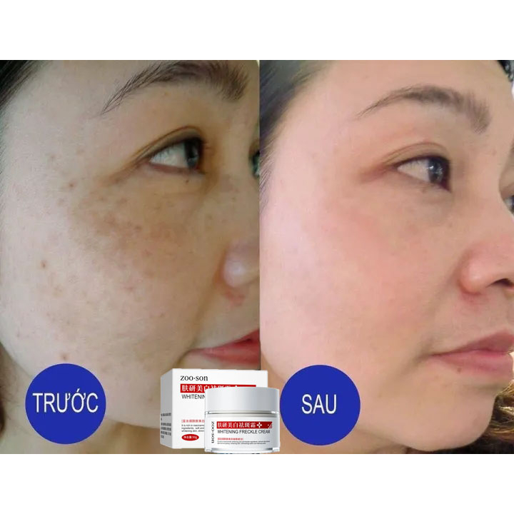 【Loại bỏ tàn nhang nhanh chóng】 Kem làm trắng da và loại bỏ tàn nhang, loại bỏ vết nám, làm mờ vết thâm, giảm tàn nhang, | BigBuy360 - bigbuy360.vn