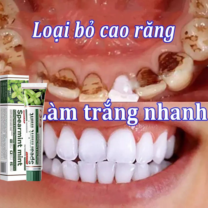 Kem đánh răng hương bạc hà SADOER ngừa sâu răng 100g,trắng răng, hơi thở thơm mát