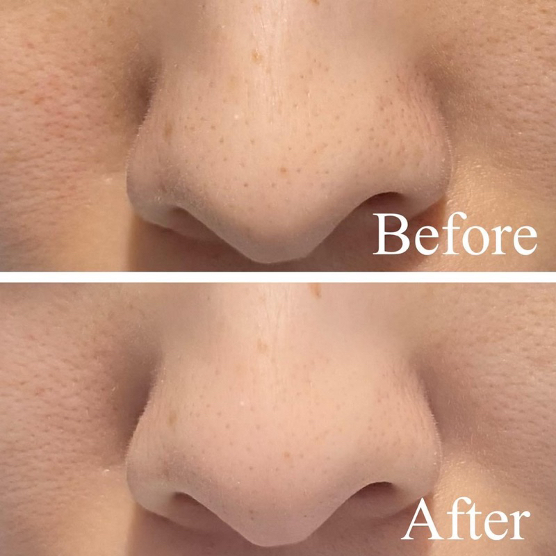 TINH CHẤT VI KIM TẨY DA CHẾT TÁI TẠO CĂNG BÓNG VT REEDLE SHOT 50ML