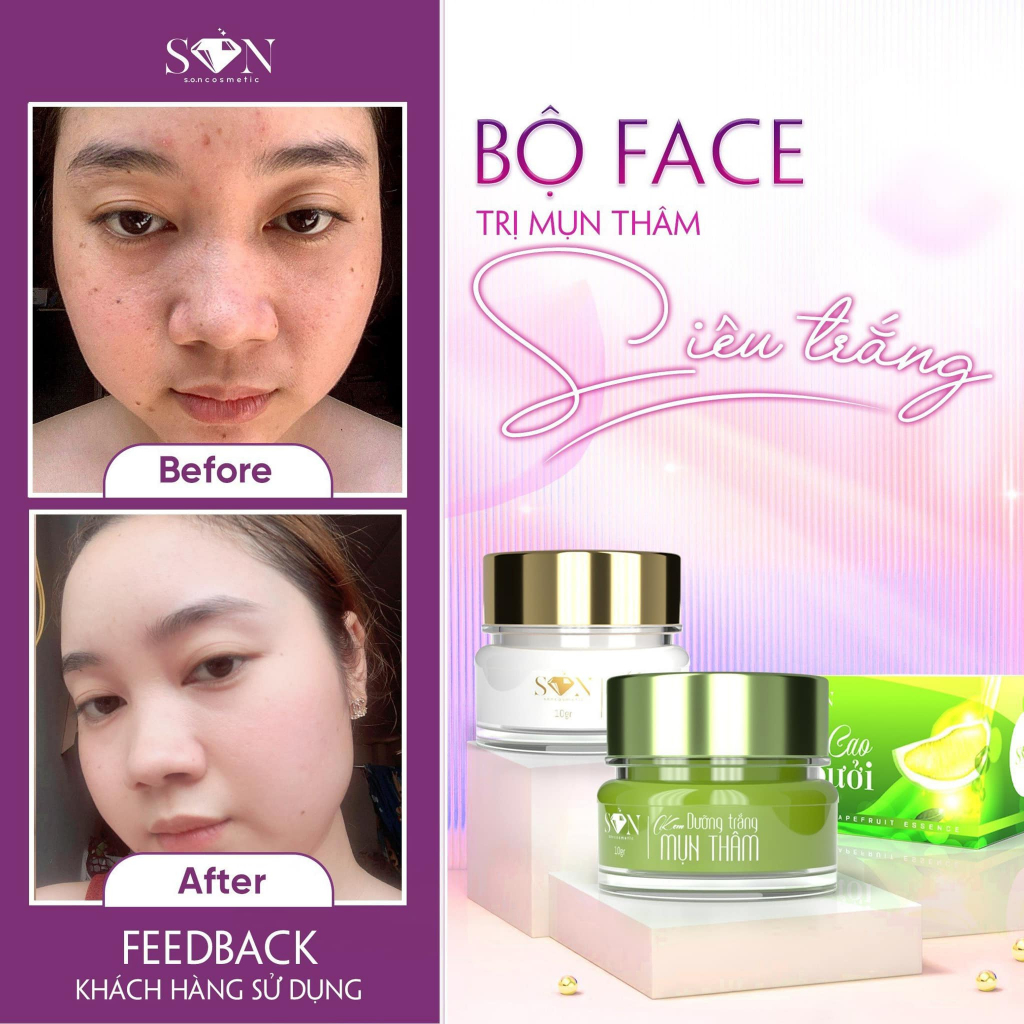 Combo face mụn, trắng da SON Nguyễn Tiên chính hãng