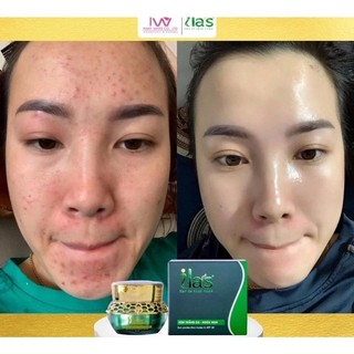 kem ilas dưỡng trắng mụn thâm 20g