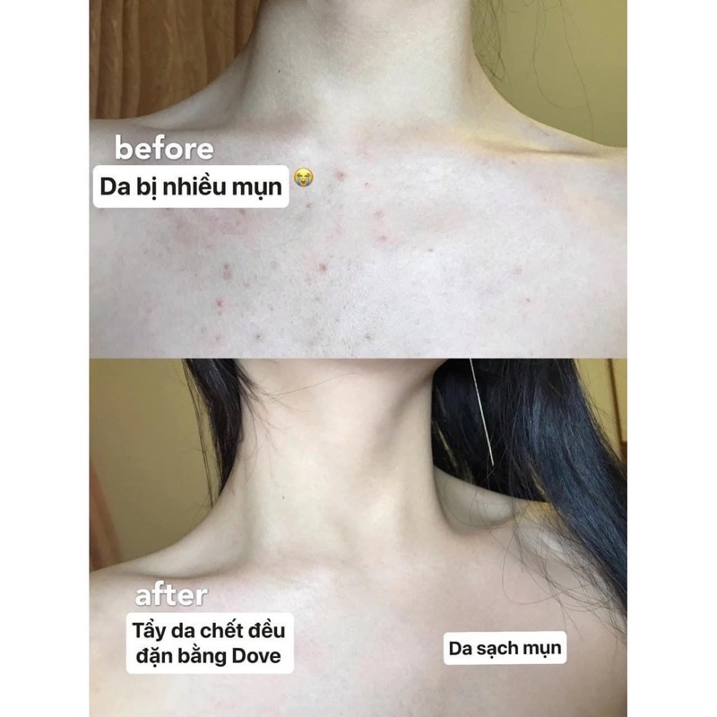 Tẩy Da Chết Toàn Thân Dove Exfoliating Body Polish - Mềm mịn da, không đau rát da và sáng da an toàn 225ml