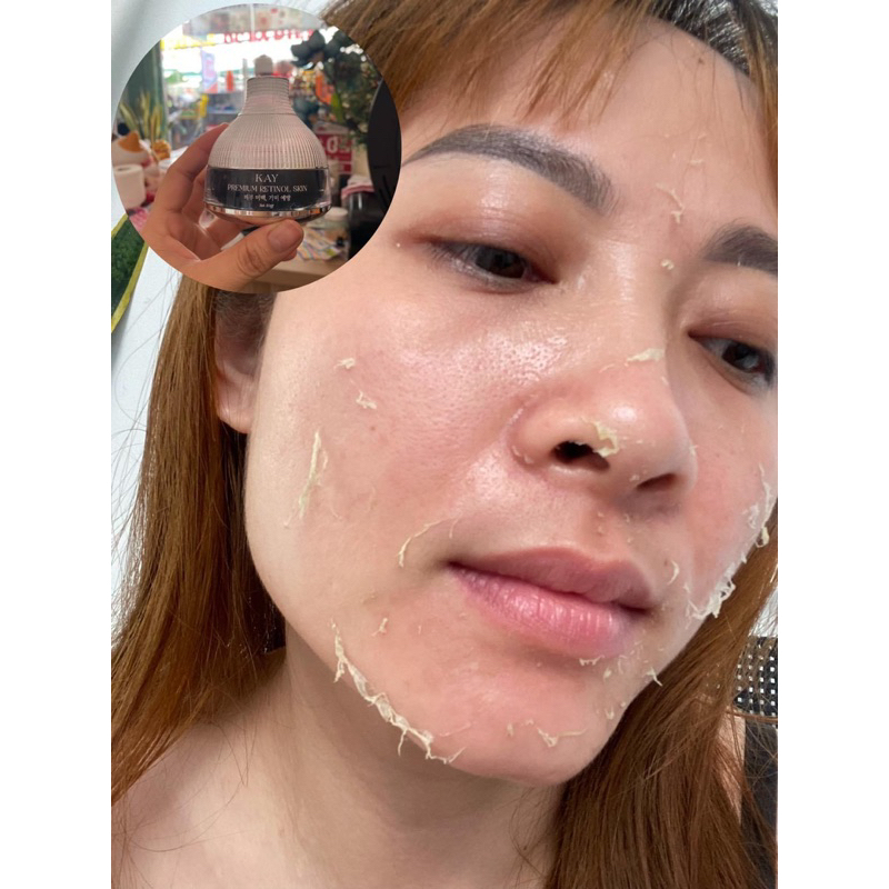 PEEL DA RETINOL KHÔNG SƯNG KHÔNG NÓNG RÁT KAY BEAUTY