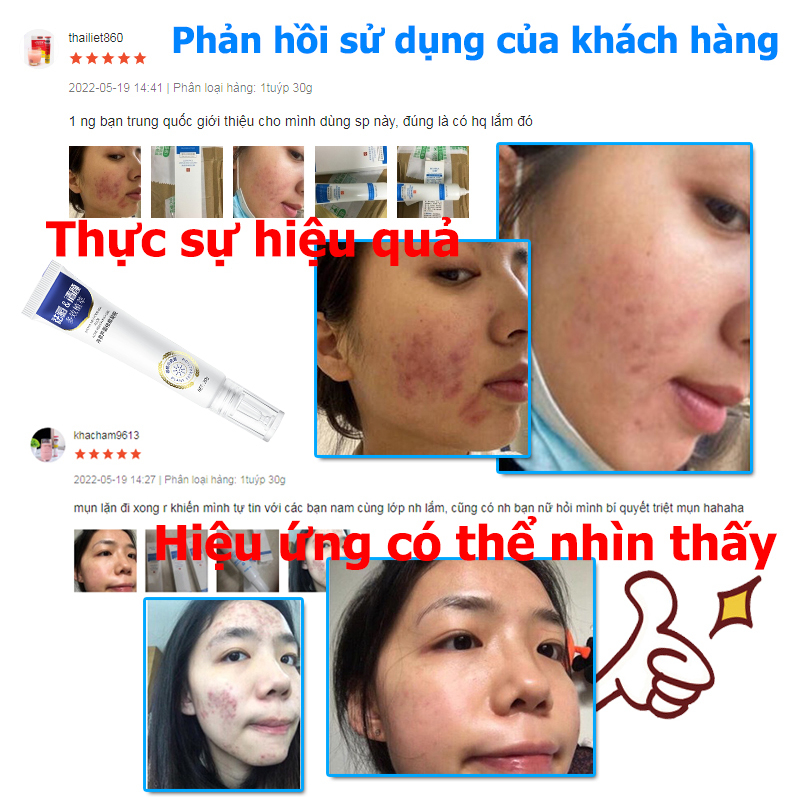 Kem thâm mụn 30g gel ngừa mụn dưỡng ẩm làm sáng da làn da mịn màng dùng cho mụn viêm, mụn bọc, mụn mủ, mụn trứng cá