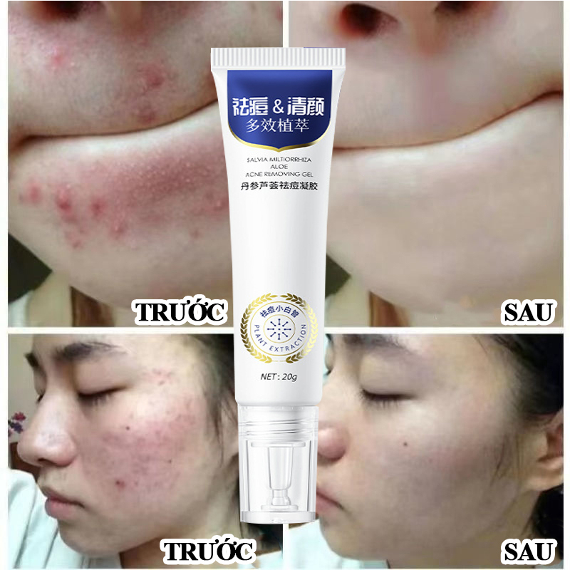 Kem thâm mụn 30g gel ngừa mụn dưỡng ẩm làm sáng da làn da mịn màng dùng cho mụn viêm, mụn bọc, mụn mủ, mụn trứng cá