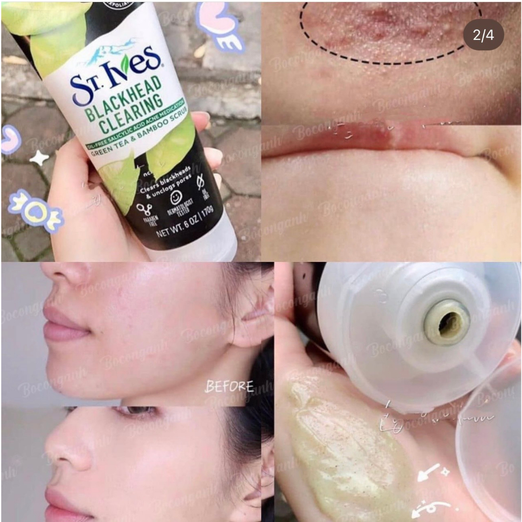 Sữa rửa mặt tẩy tế bào chết ST.Ives chiết xuất trà xanh làm sạch sâu và mịn da 170g Mỹ