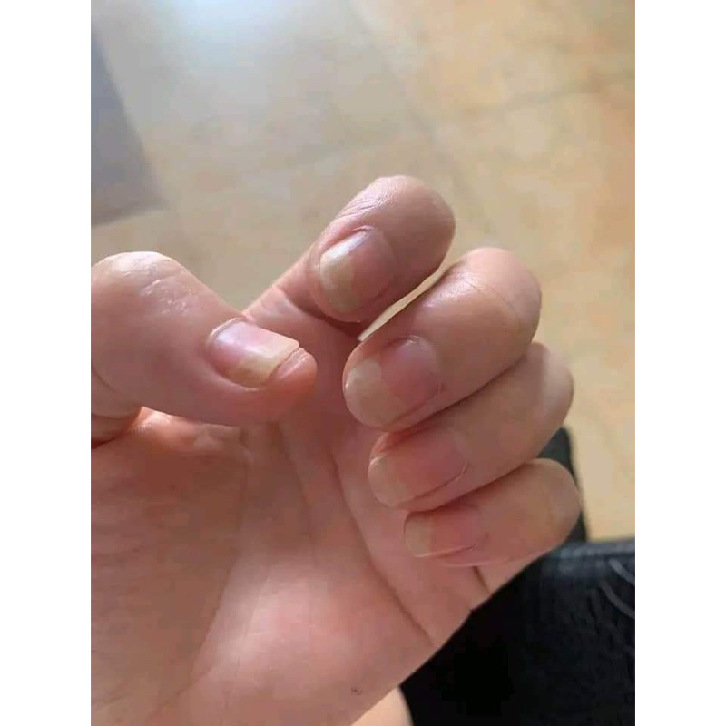 Serum đánh bay nấm móng, hư khoé, bọng móng, nước ăn tay chân gia truyền 4ml