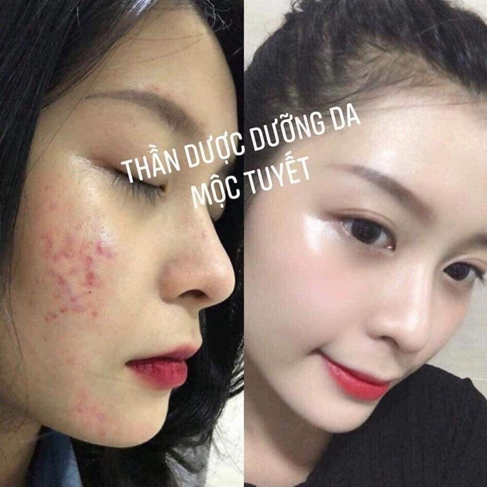 Serum huyet  thanh giảm mun giam thâm MT, Tặng kèm túi giấy của hãng