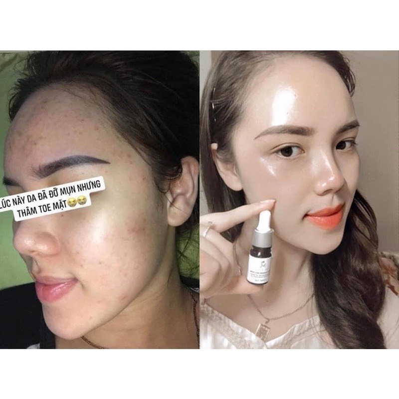 Serum huyet  thanh giảm mun giam thâm MT, Tặng kèm túi giấy của hãng