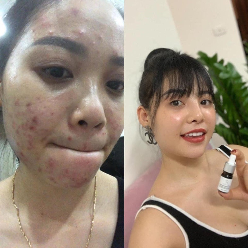 Serum huyet  thanh giảm mun giam thâm MT, Tặng kèm túi giấy của hãng