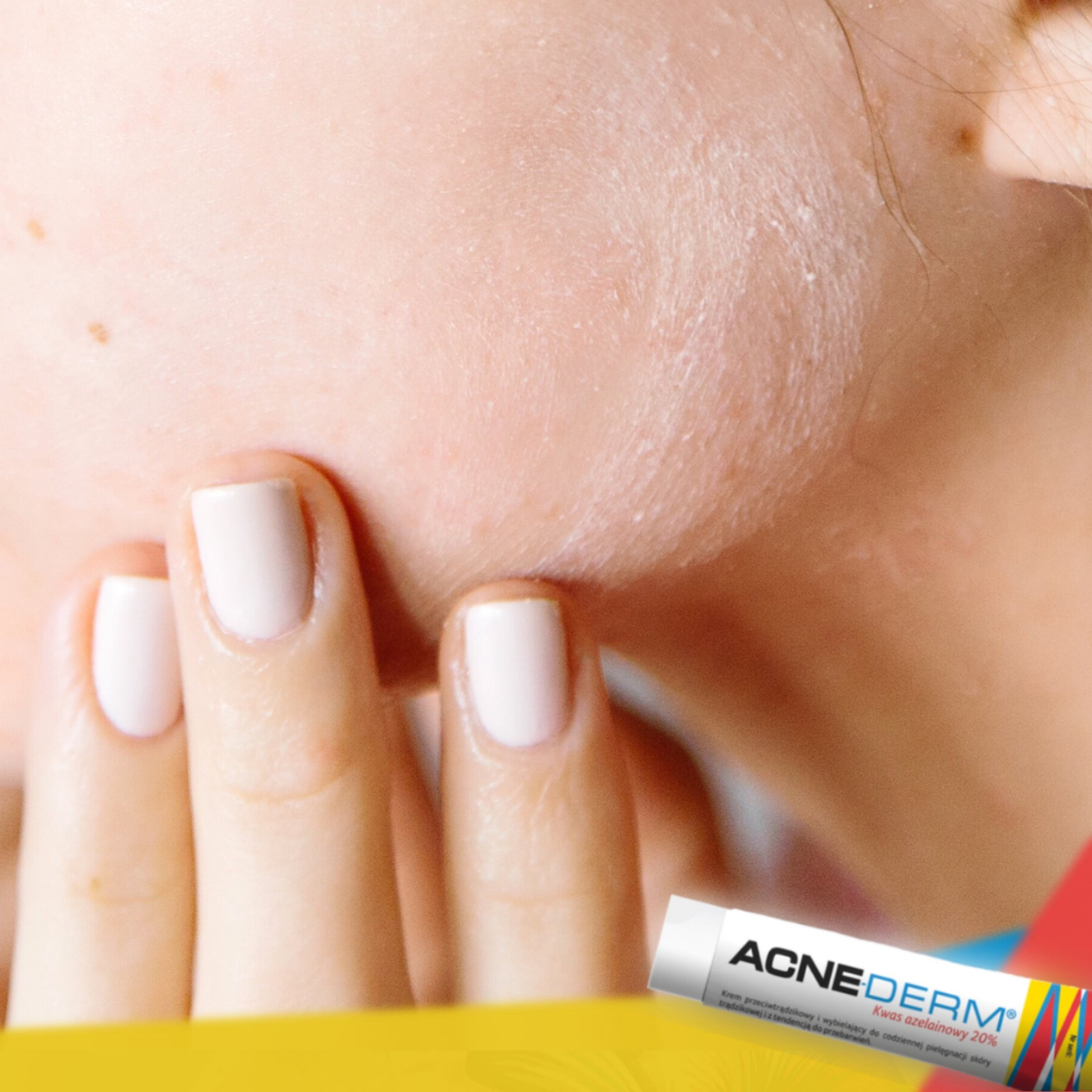 Gel Giảm Mụn Acnederm 20g Giảm Thâm Mờ Nám