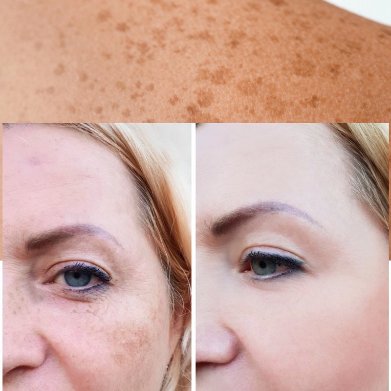 Serum Spa Mờ Thâm Nám Thailan lọ 10ml