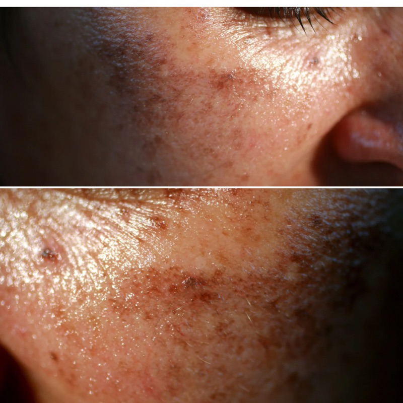 Serum Spa Mờ Thâm Nám Thailan lọ 10ml