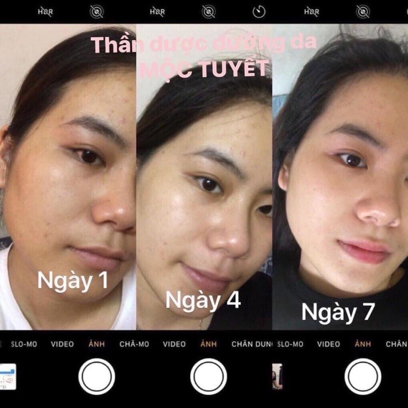 Serum huyết thanh giảm mụn mờ thâm và dưỡng trắng da mặt, se khít lỗ chân lông và làm đẹp da