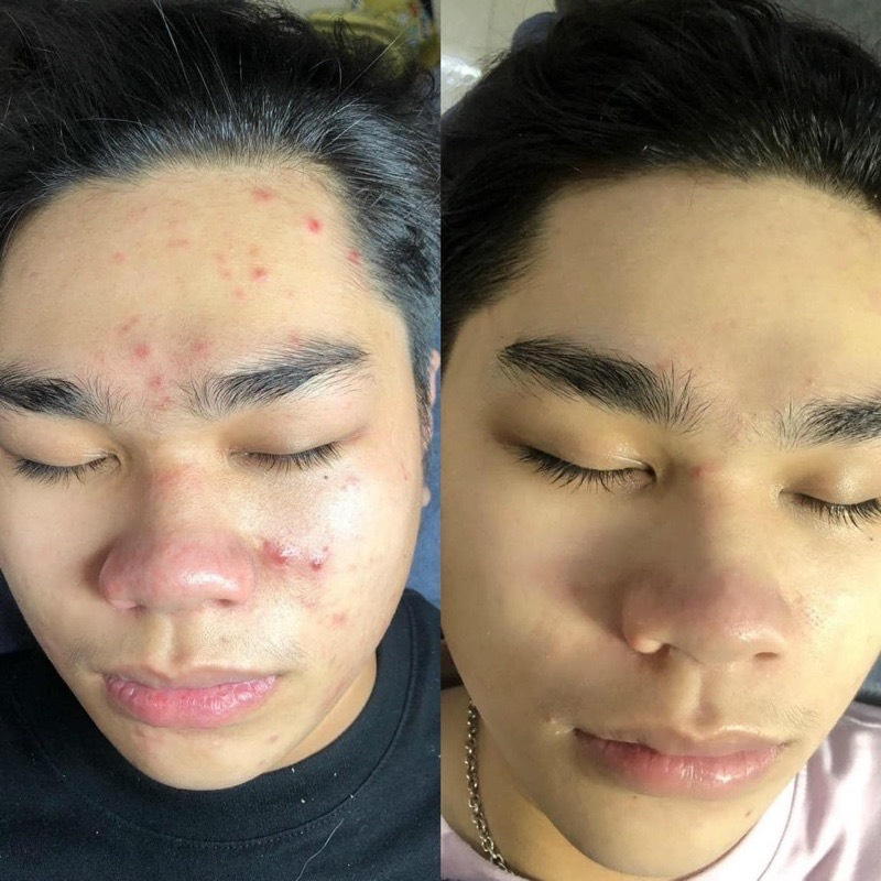 Serum huyết thanh giảm mụn mờ thâm và dưỡng trắng da mặt, se khít lỗ chân lông và làm đẹp da