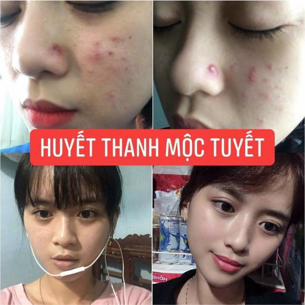 Serum huyết thanh giảm mụn mờ thâm và dưỡng trắng da mặt, se khít lỗ chân lông và làm đẹp da