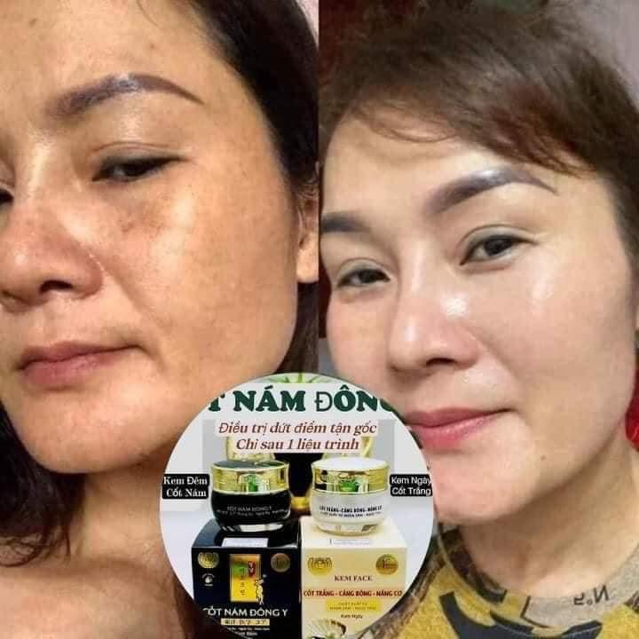 Combo Kem Face Cốt Nám Đông Y Nikos Chính Hãng- Kem Face Nikos Cốt Trắng Căng Bóng Nâng Cơ