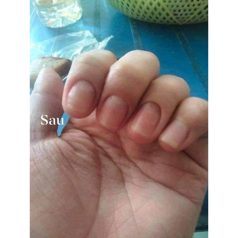 Serum đánh bay nấm móng, hư khoé, bọng móng, nước ăn tay chân gia truyền 4ml