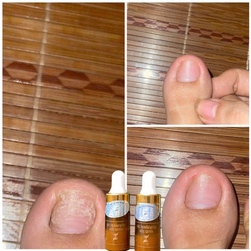 Serum đánh bay nấm móng, hư khoé, bọng móng, nước ăn tay chân gia truyền 4ml