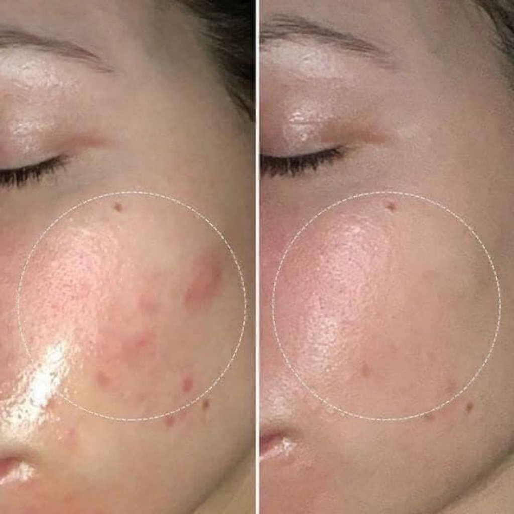 Kem Dưỡng Dermacos Anti Acne Matting Cream 50ml Dưỡng Da Kiềm Dầu Giảm Bóng Nhờn, Ngừa Mụn