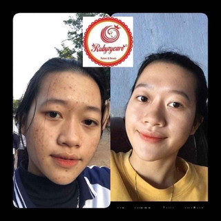 BAY MỤN RubyCare