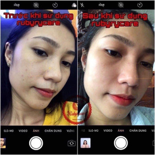 BAY MỤN RubyCare