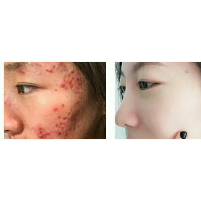 5ML Cao lá nam Mix saffron xóa sạch mụn,thâm do mụn