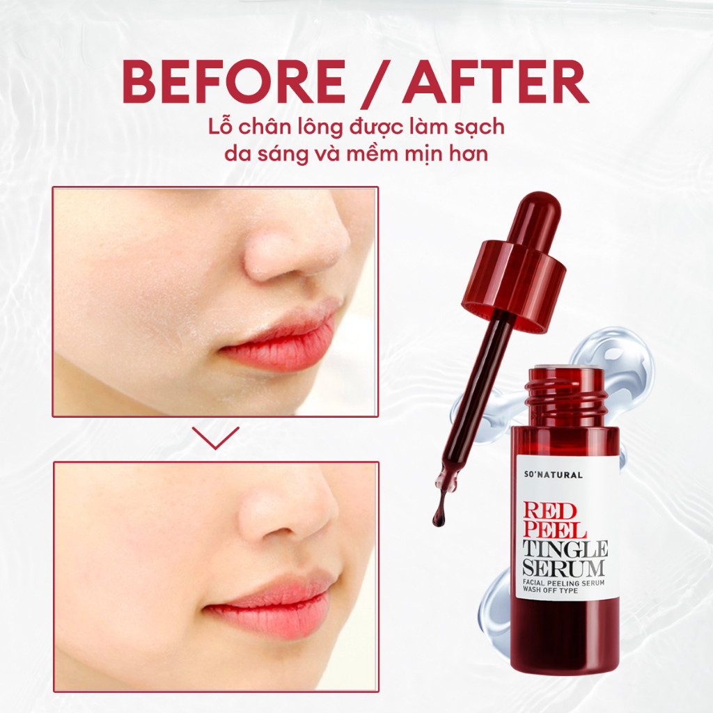 Tinh chất Red Peel Tingle Serum tái tạo da sinh học mờ thâm trắng da So Natural 35ml
