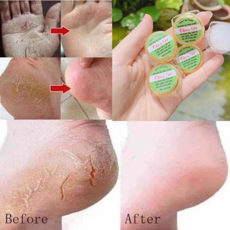 Kem Bôi Da Bôi Nứt Gót Chân Gia Truyền Thiên Di - Kem Bôi Chàm Sữa Hăm Tả Hết Nứt Gót Chân Dưỡng Ẩm Da