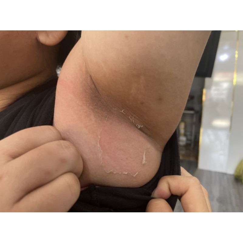 COMBO PEEL SẠCH THÂM NÁCH MÔNG BẸN ĐẦU GỐI VẾT MUỖI ĐỐT