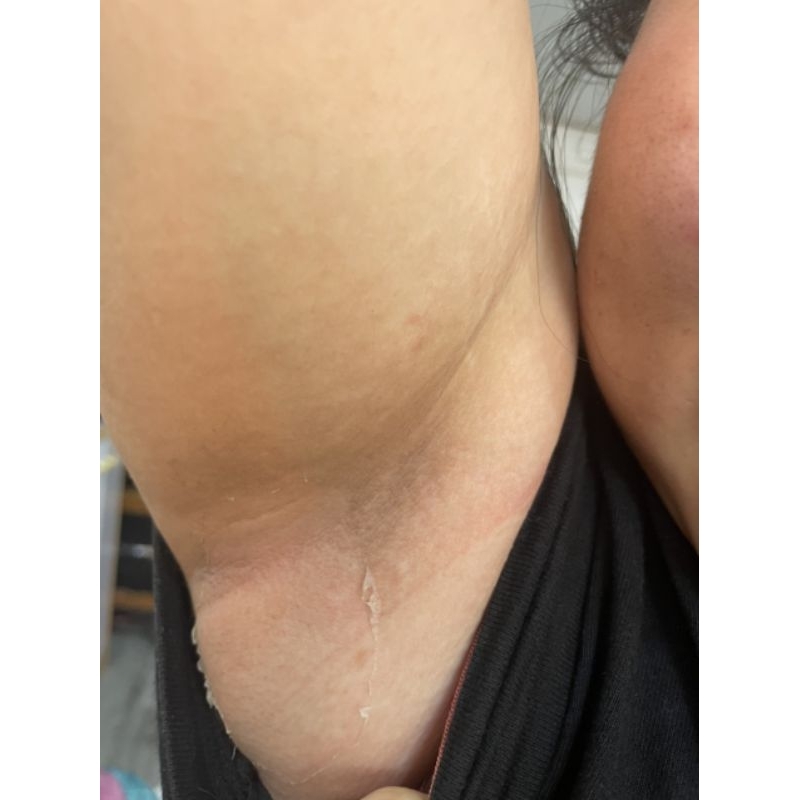 COMBO PEEL SẠCH THÂM NÁCH MÔNG BẸN ĐẦU GỐI VẾT MUỖI ĐỐT