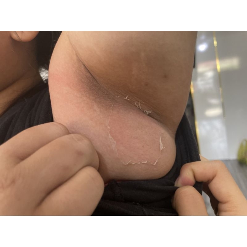 COMBO PEEL SẠCH THÂM NÁCH MÔNG BẸN ĐẦU GỐI VẾT MUỖI ĐỐT